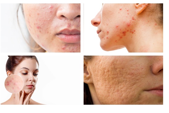 Best acne treatment: home remedy, Tips for Acne Spot