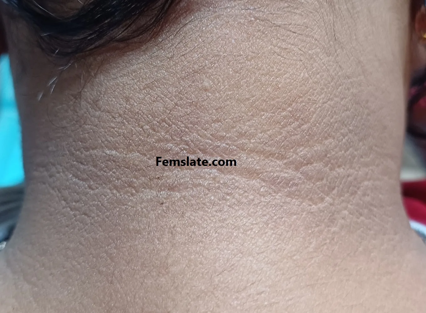 Dark neck or Velvet Skin