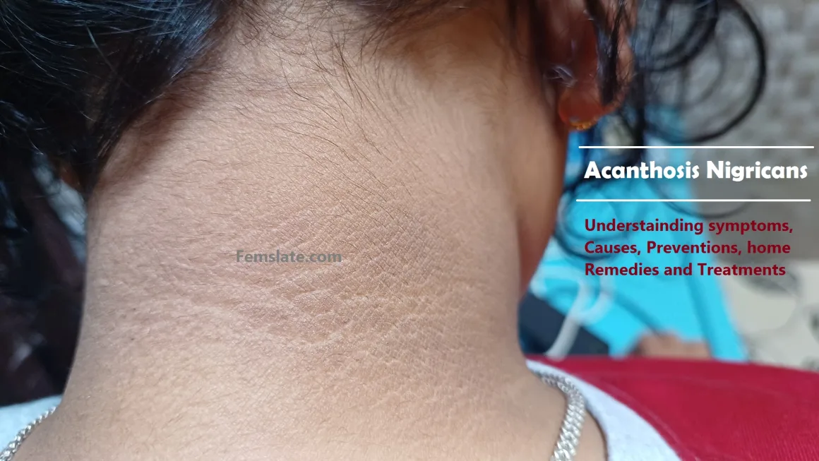 What is Acanthosis Nigricans